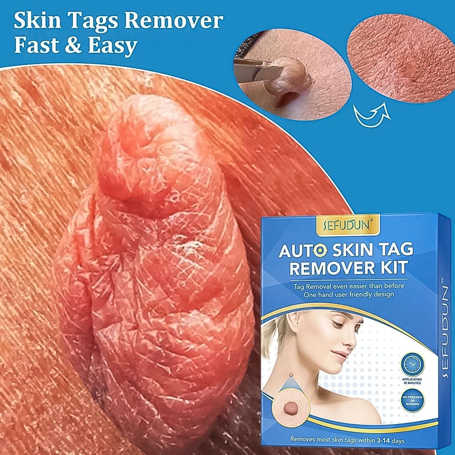 Skin Tag Remover Kit 2 in 1 for Micro to Large (2 mm - 8 mm / 1 Set)-Health & Personal Care-AniGuess-AniGuess