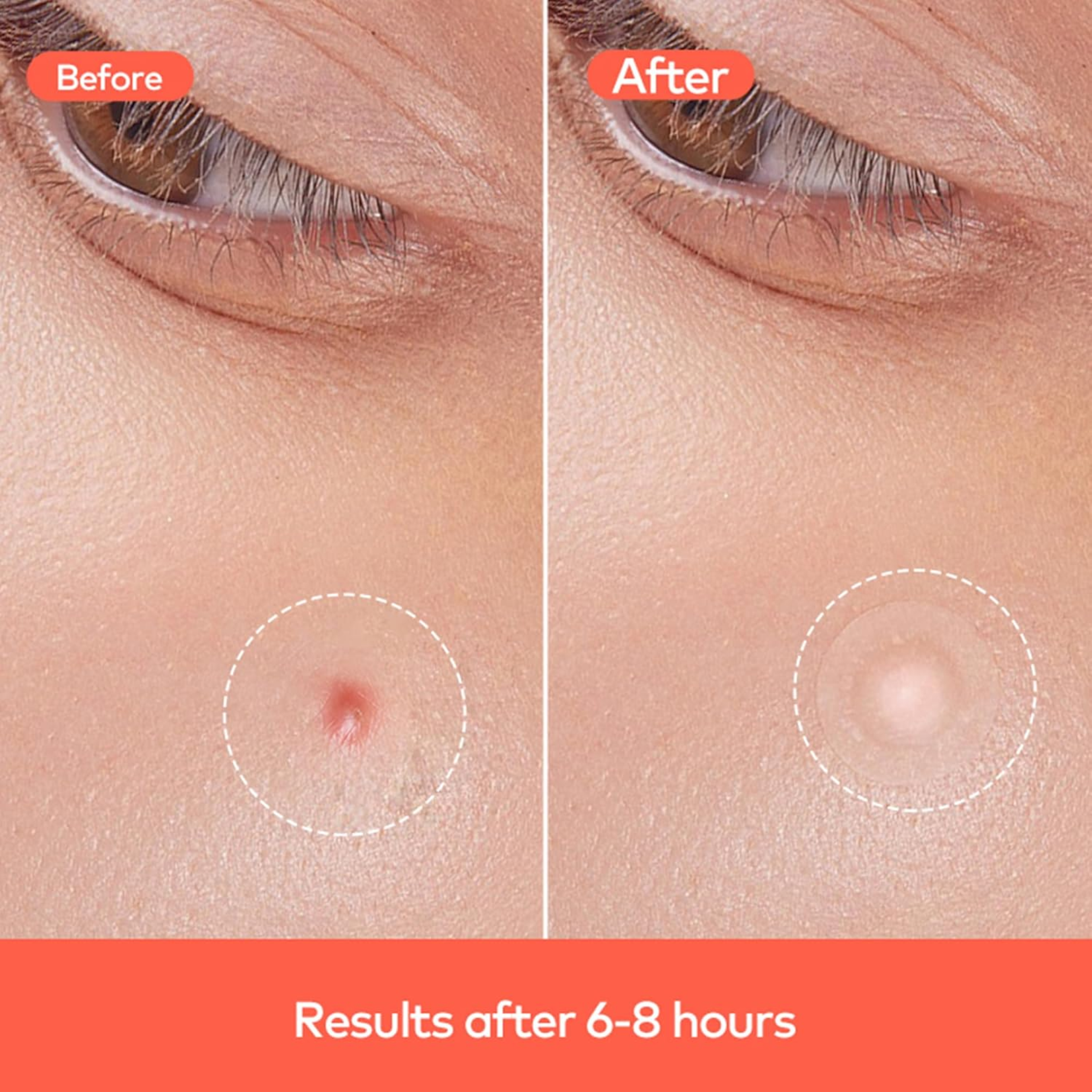 Pimple Patches for Face (1 Sheet Set)-Health & Personal Care-AniGuess-AniGuess